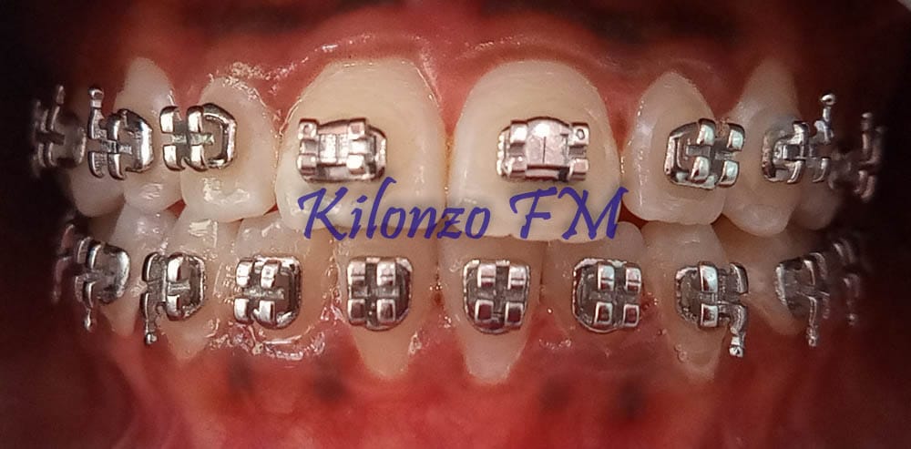 Dental Braces