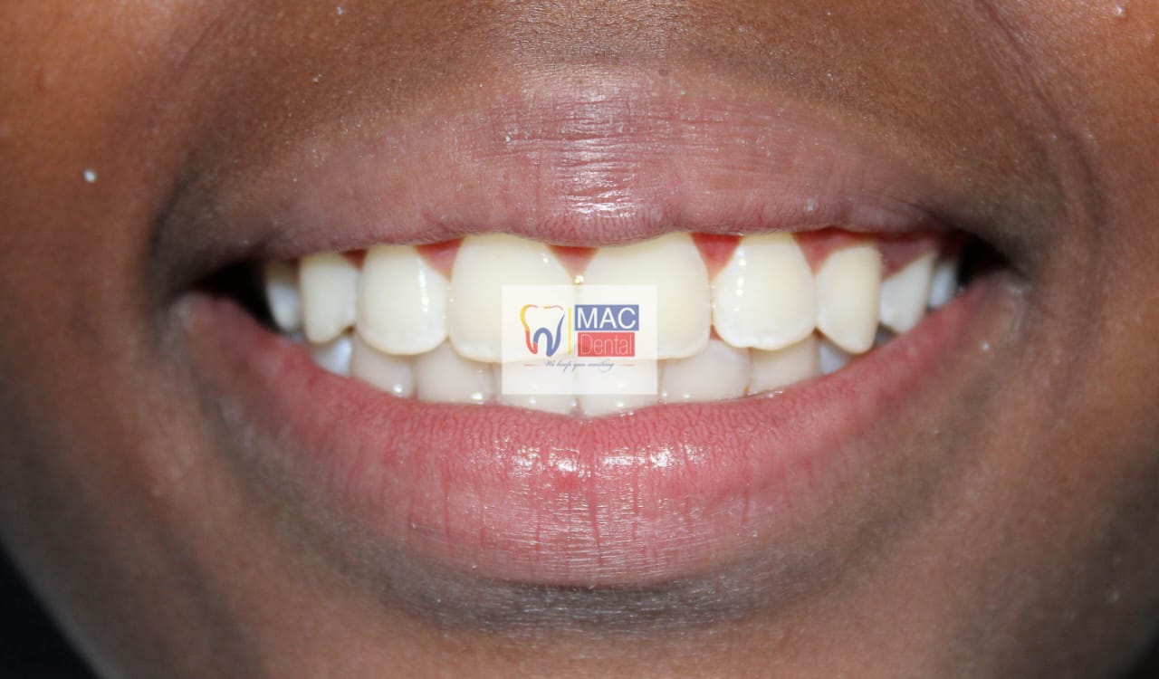 mac dental braces 2