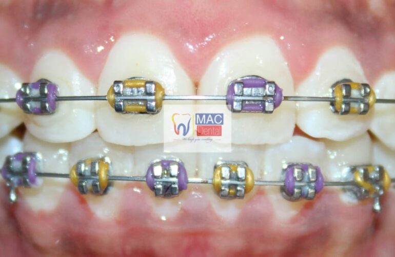 mac dental braces