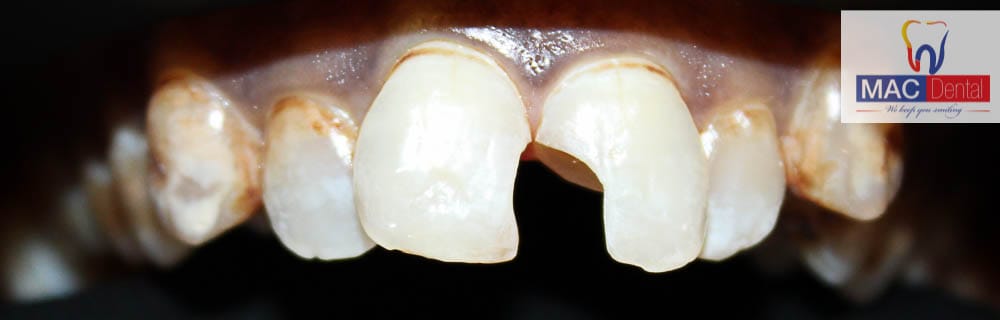 Dental Fillings in Kenya